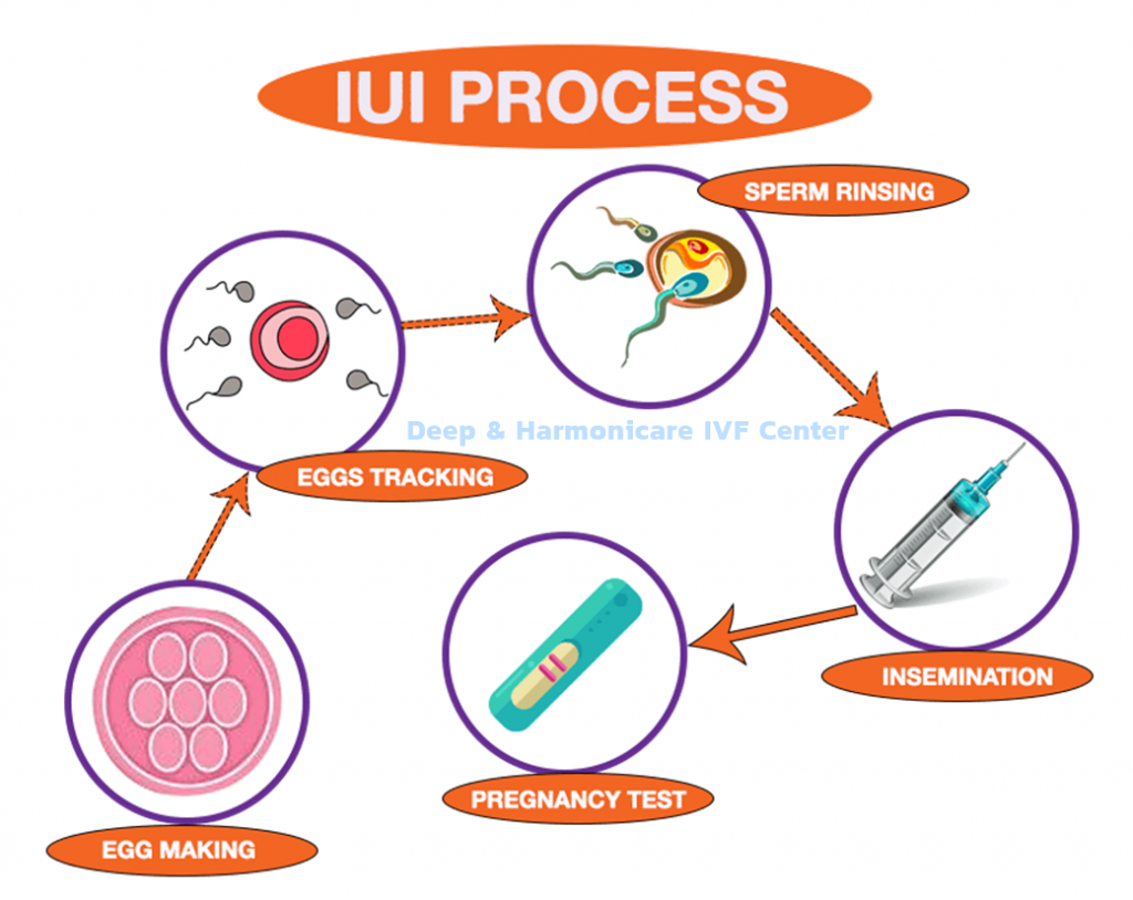 IUI คืออะไร